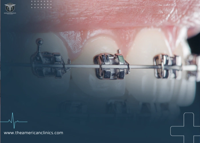 اختیار تقويم الاسنان الامثل اختیار تقويم الاسنان الامثل