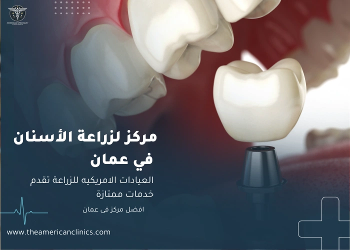 مركز لزراعة الأسنان في عمان مركز لزراعة الاسنان في عمان