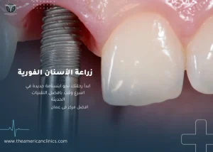 زراعة الأسنان الفورية